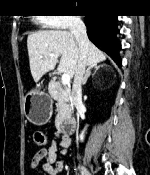 Adrenal myelolipoma (Radiopaedia 82742-96986 Sagittal renal cortical phase 47).jpg