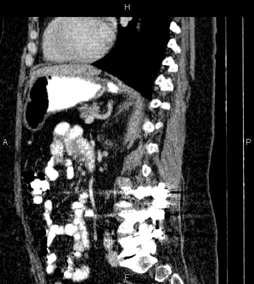 Adrenal myelolipoma (Radiopaedia 84319-99617 Sagittal renal cortical phase 57).jpg