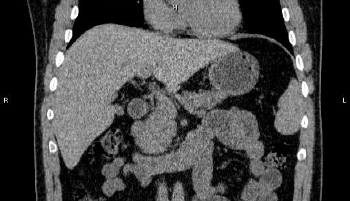 Adrenal myelolipoma (Radiopaedia 84321-99619 Coronal non-contrast 34).jpg