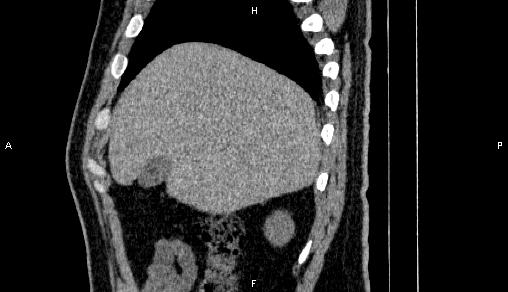 Adrenal myelolipoma (Radiopaedia 84321-99619 Sagittal non-contrast 20).jpg