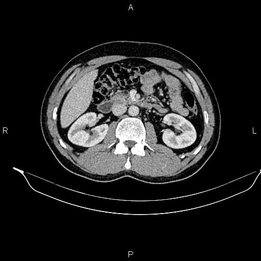 Adrenal myelolipoma (Radiopaedia 87794-104246 Axial renal cortical phase 45).jpg