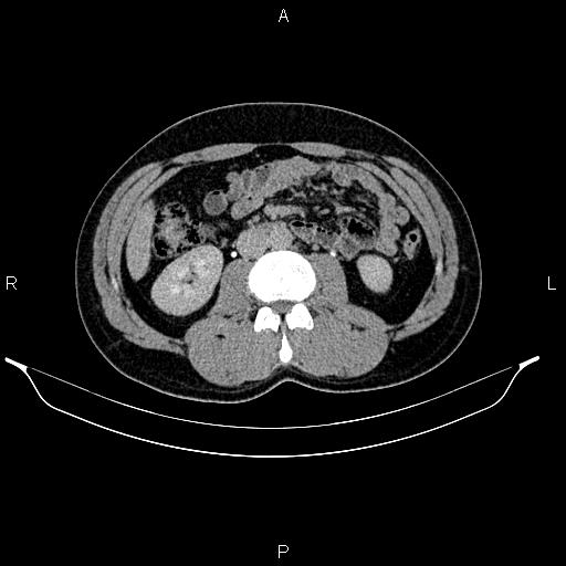 Adrenal myelolipoma (Radiopaedia 87794-104246 Axial renal excretory phase 50).jpg