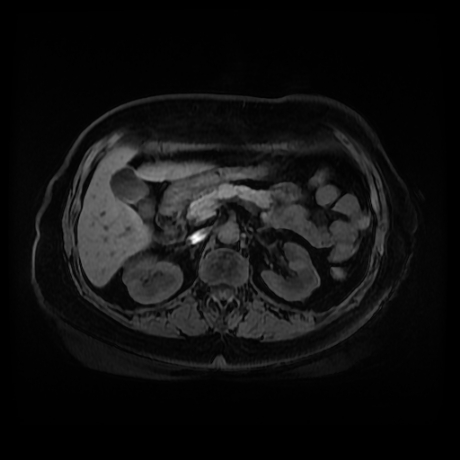 Adrenal myelolipoma - MRI (Radiopaedia 83249-97646 Axial T1 fat sat 36).jpg