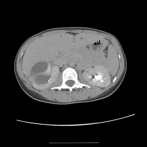Adult polycystic kidney disease (Radiopaedia 48845-53876 Axial renal excretory phase 36).jpg