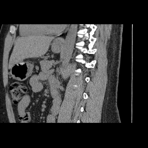 Adult polycystic kidney disease (Radiopaedia 59075-66368 Sagittal non-contrast 50).jpg