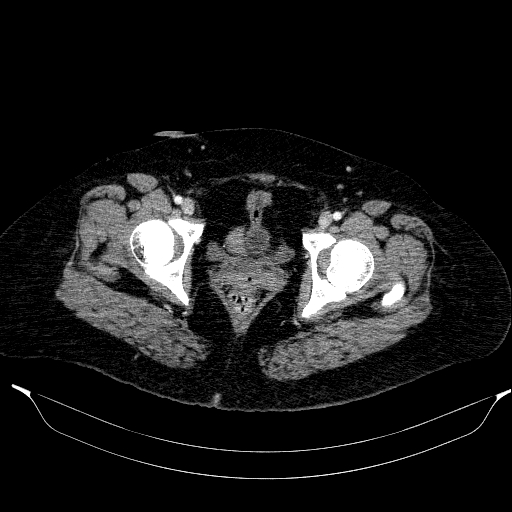Afferent loop syndrome - secondary to incarcerated trocar site hernia (Radiopaedia 82959-97305 Axial C+ portal venous phase 224).jpg