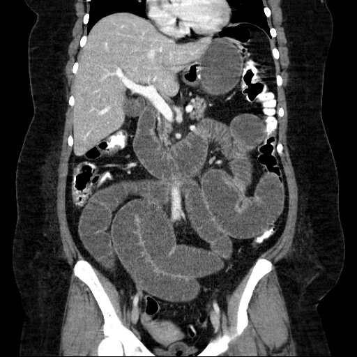 File:Afferent loop syndrome - secondary to incarcerated trocar site hernia (Radiopaedia 82959-97305 Coronal C+ portal venous phase 79).jpg