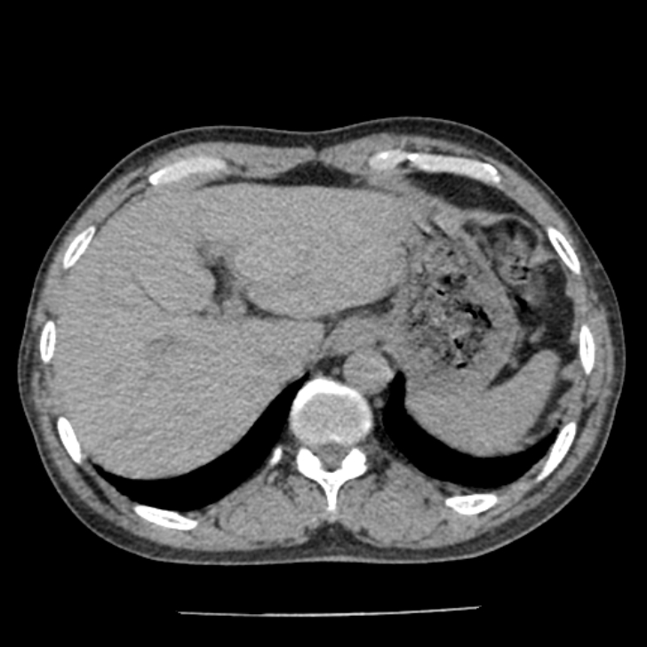 Airway foreign body in adult (Radiopaedia 85907-101779 Axial liver window 188).jpg