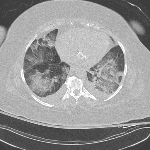 All trans retinoic acid (ATRA) syndrome (Radiopaedia 38212-40229 Axial lung window 38).jpg