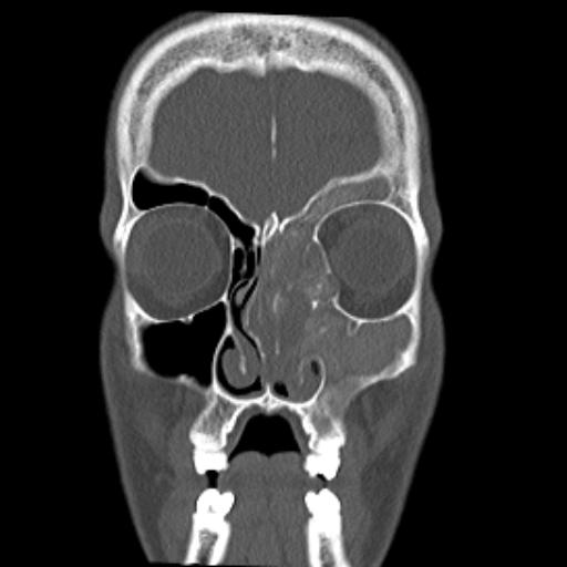 File:Allergic fungal sinusitis (Radiopaedia 29086-29455 Coronal bone window 15).jpg