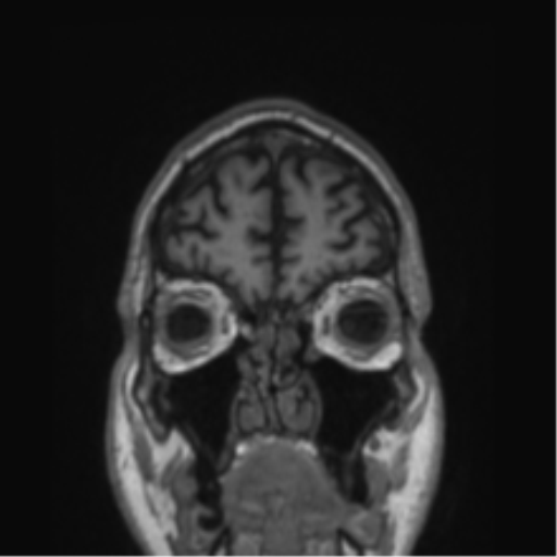 Alzheimer's disease- with Gerstmann syndrome and dressing apraxia (Radiopaedia 54882-61150 Coronal T1 80).png