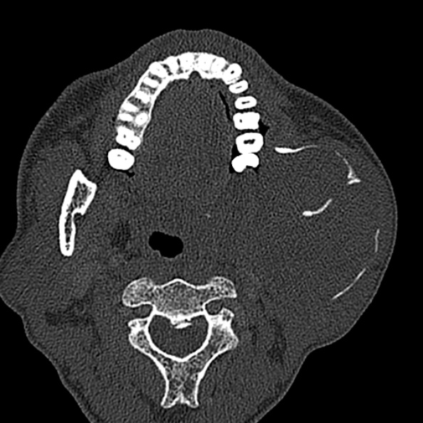 Ameloblastoma (Radiopaedia 51921-57766 Axial bone window 89).jpg