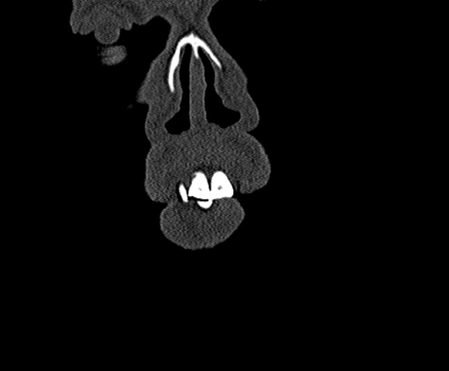 Ameloblastoma (Radiopaedia 51921-57766 Coronal bone window 1).jpg