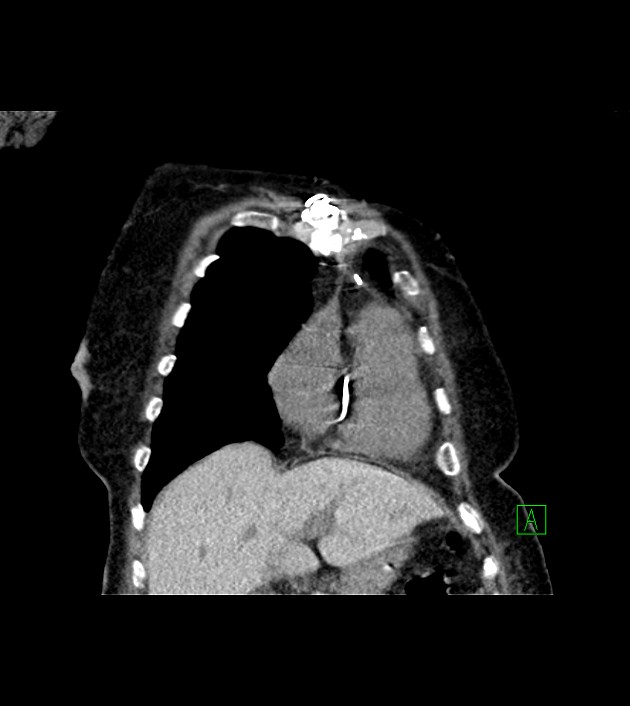 Amiodarone deposition in the liver (Radiopaedia 77587-89780 Coronal non-contrast 21).jpg