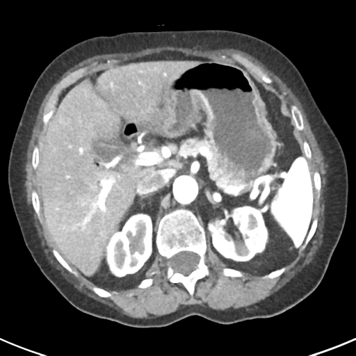 File:Ampullary adenocarcinoma (Radiopaedia 34013-35237 B 25).png