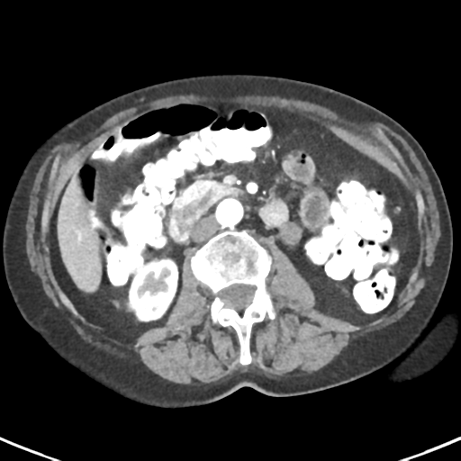 Ampullary adenocarcinoma (Radiopaedia 34013-35237 B 44).png