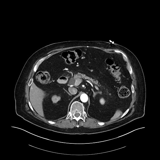 Ampullary adenocarcinoma (Radiopaedia 59373-66734 A 55).jpg