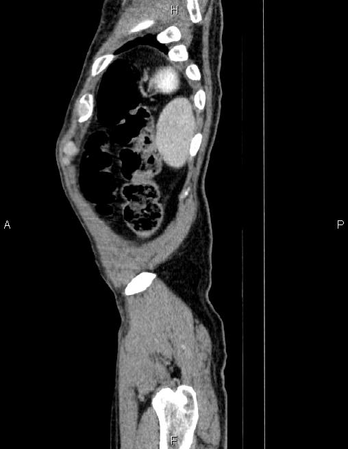 Ampullary adenocarcinoma (Radiopaedia 86093-102032 D 92).jpg