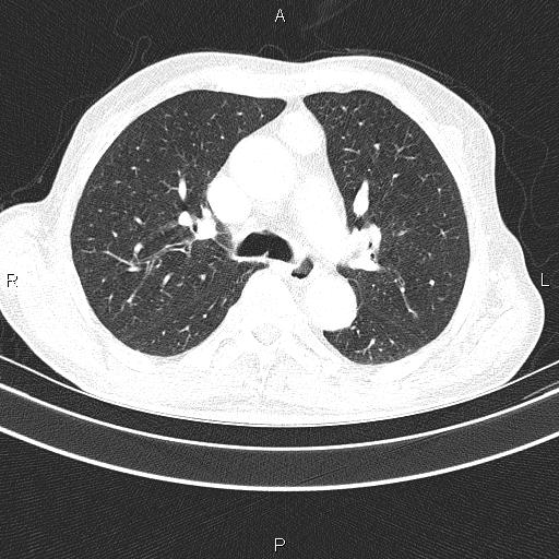File:Ampullary adenocarcinoma (Radiopaedia 86093-102033 Axial lung window 28).jpg