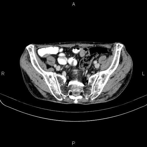 Ampullary adenocarcinoma (Radiopaedia 86093-102033 B 95).jpg