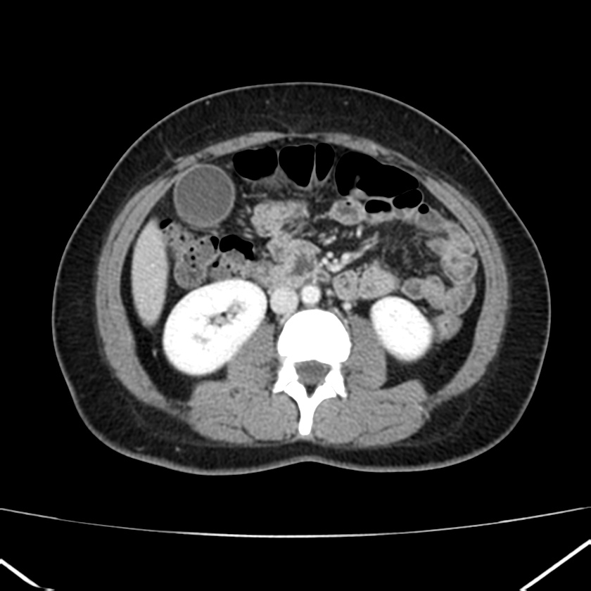 Ampullary tumor (Radiopaedia 22787-22816 C 33).jpg