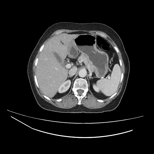 Ampullary tumor (Radiopaedia 60333-67998 A 19).jpg