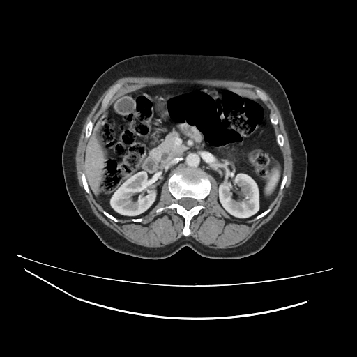 Ampullary tumor (Radiopaedia 60333-67998 A 30).jpg