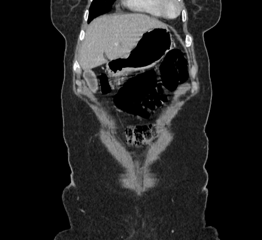 Ampullary tumor (Radiopaedia 60333-67998 B 10).jpg