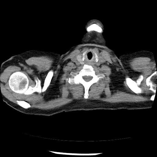 File:Amyloidosis - bronchial and diffuse nodular pulmonary involvement (Radiopaedia 60156-67744 Axial non-contrast 1).jpg