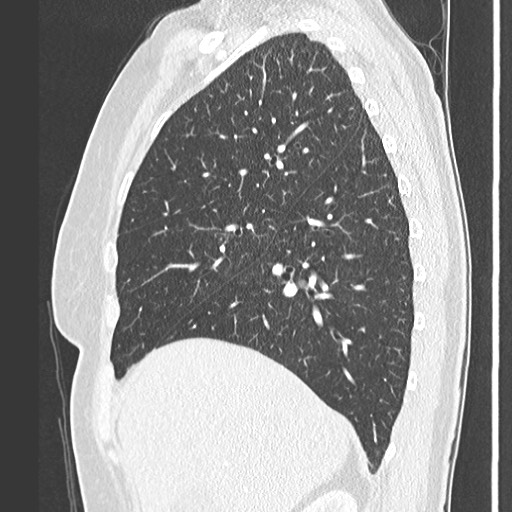 Amyloidosis - bronchial and diffuse nodular pulmonary involvement (Radiopaedia 60156-67745 Sagittal lung window 27).jpg