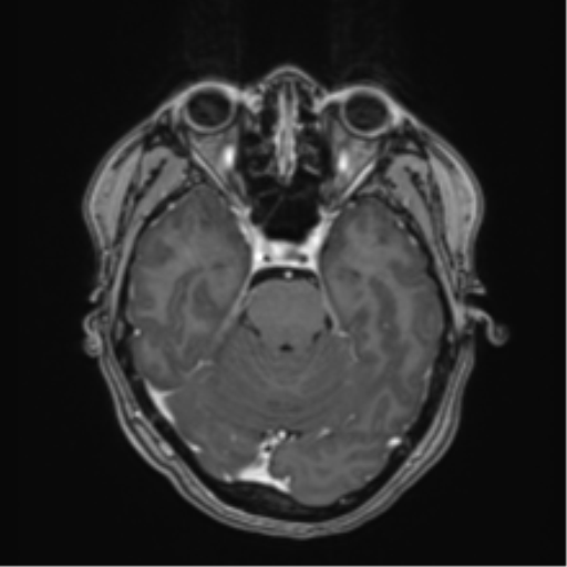 Anaplastic astroblastoma (Radiopaedia 55666-62194 Axial T1 C+ 25).png
