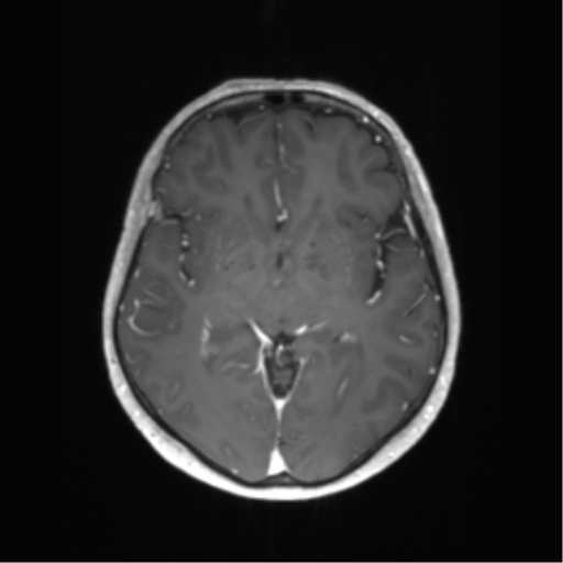 File:Anaplastic astrocytoma (Radiopaedia 86943-103160 Axial T1 C+ 22).png