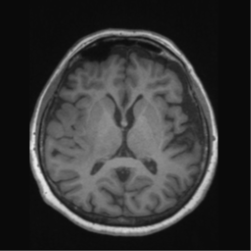 Anaplastic astrocytoma IDH wild-type (pseudoprogression) (Radiopaedia 42209-45276 Axial T1 83).png