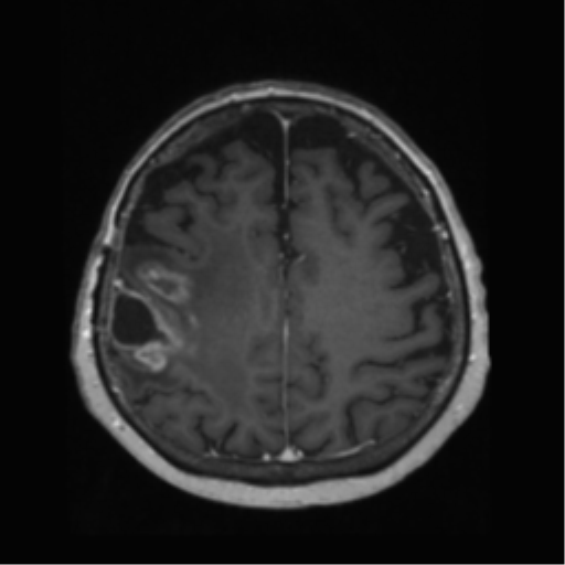 File:Anaplastic astrocytoma IDH wild-type (pseudoprogression) (Radiopaedia 42209-45278 Axial T1 C+ 111).png