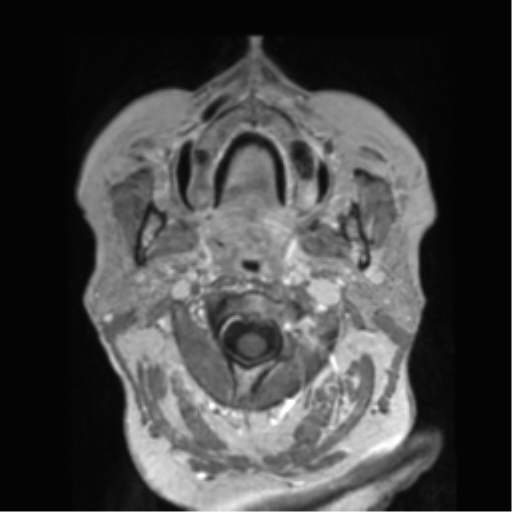 Anaplastic astrocytoma IDH wild-type (pseudoprogression) (Radiopaedia 42209-45278 Axial T1 C+ 5).png