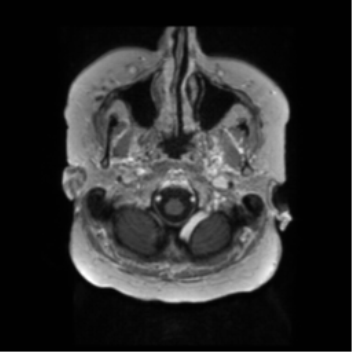 File:Anaplastic astrocytoma IDH wild-type (pseudoprogression) (Radiopaedia 42209-45279 Axial T1 C+ 15).png