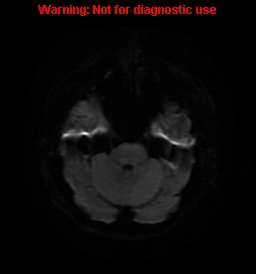 File:Anaplastic ganglioglioma (Radiopaedia 44921-48831 Axial DWI 7).jpg