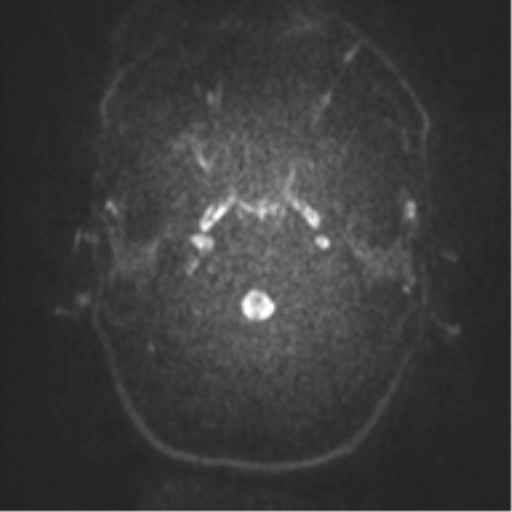 Anaplastic oligodendroglioma (Radiopaedia 37667-39563 Axial DWI 22).png