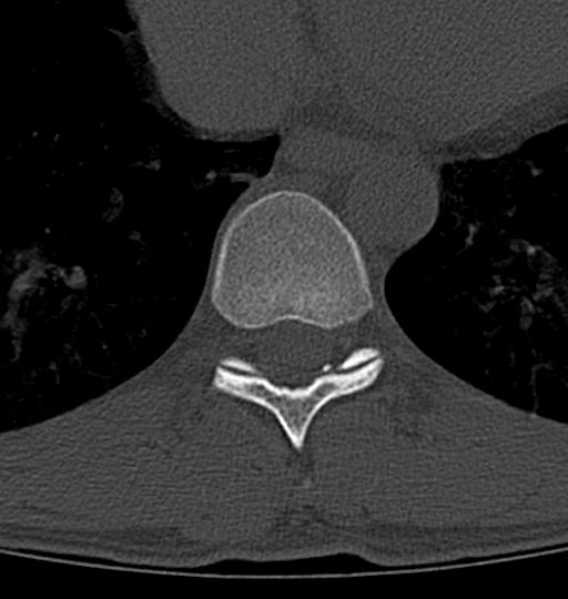 Aneurysmal bone cyst T11 (Radiopaedia 29294-29721 Axial bone window 26).jpg