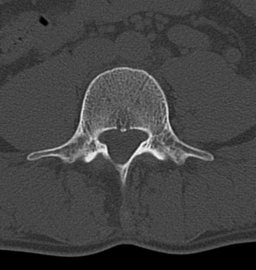 Aneurysmal bone cyst T11 (Radiopaedia 29294-29721 Axial bone window 99).jpg