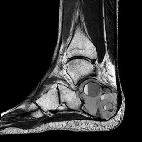 File:Aneurysmal bone cyst of the calcaneus (Radiopaedia 60669-68420 Sagittal PD 8).jpg