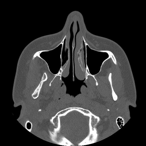 Aneurysmal bone cyst of the mandible (Radiopaedia 43280-46823 Axial bone window 118).jpg