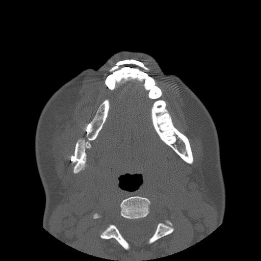 Aneurysmal bone cyst of the mandible (Radiopaedia 43280-46823 Axial bone window 54).jpg