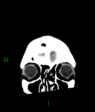 Aneurysmal subarachnoid hemorrhage with intra-axial extension (Radiopaedia 84371-99699 Coronal non-contrast 59).jpg