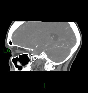 Aneurysmal subarachnoid hemorrhage with intra-axial extension (Radiopaedia 84371-99732 B 25).jpg