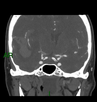 File:Aneurysmal subarachnoid hemorrhage with intra-axial extension (Radiopaedia 84371-99732 C 58).jpg
