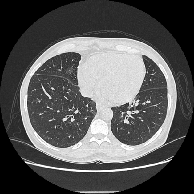Angioinvasive aspergellosis (Radiopaedia 66995-76315 Axial lung window 36).jpg