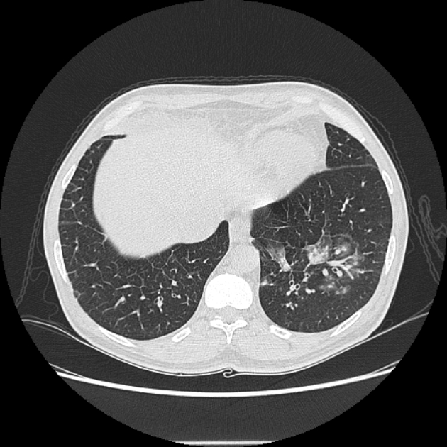 Angioinvasive aspergellosis (Radiopaedia 66995-76315 Axial lung window 42).jpg