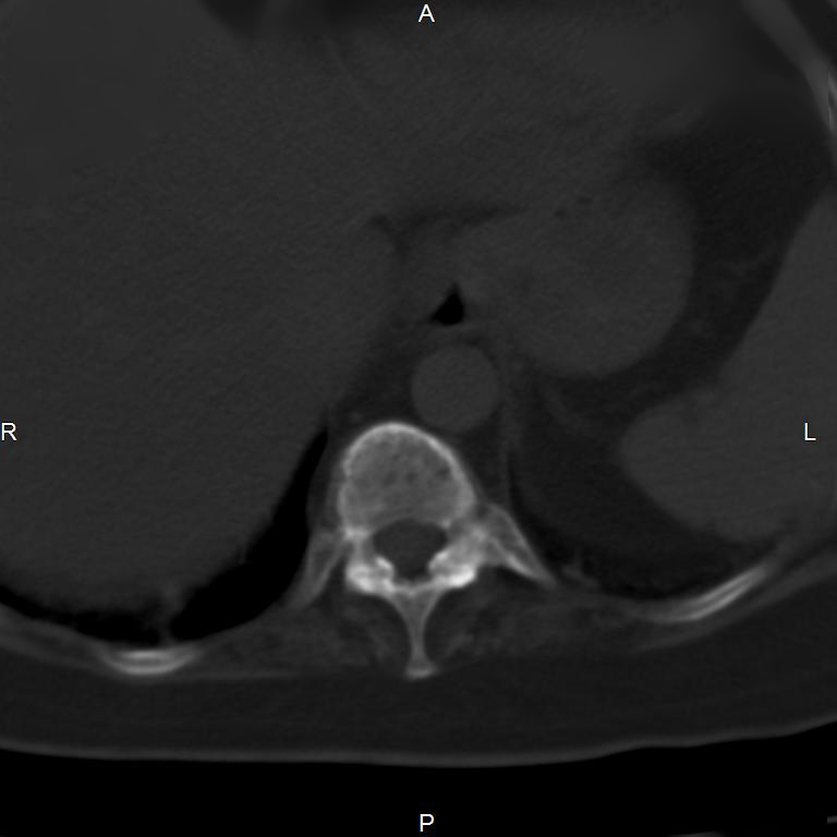 Ankylosing spondylitis (Radiopaedia 8748-9556 Axial bone window 9).jpg