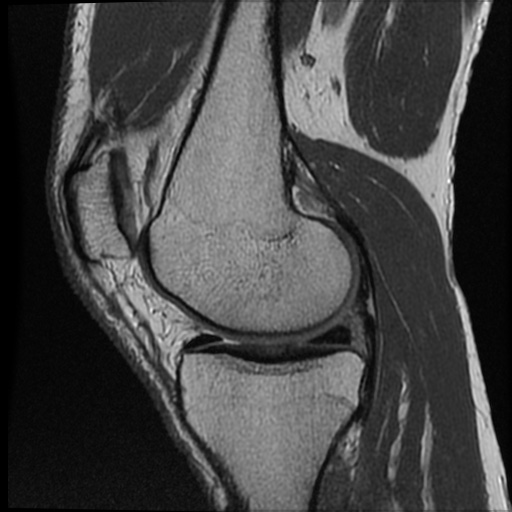 Anomalous insertion of the medial meniscus (Radiopaedia 77559-89721 Sagittal PD 35).jpg
